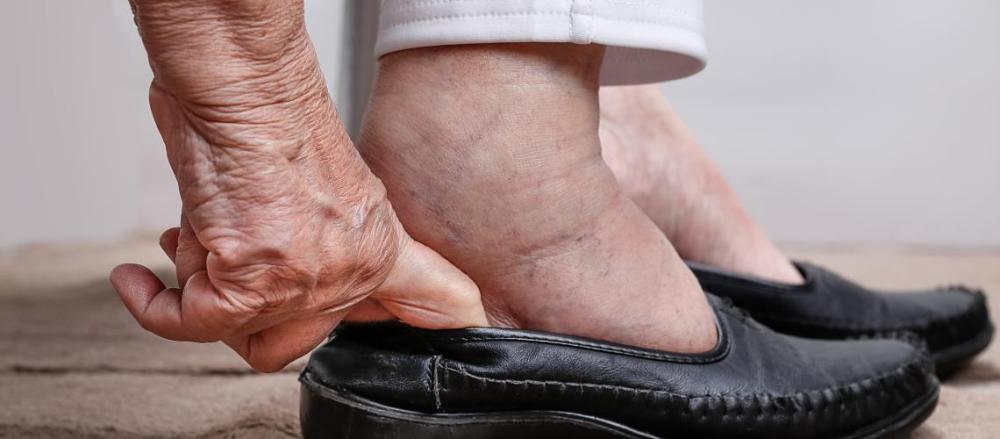 Pessoa calçando sapato, com pés inchados
