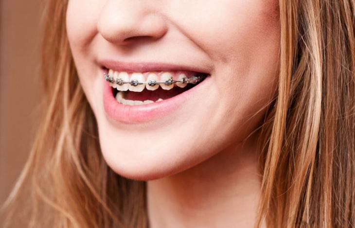 Imagem de uma jovem usando aparelho dentário, indicando os fatores que podem alterar a cor da borrachinha do aparelho