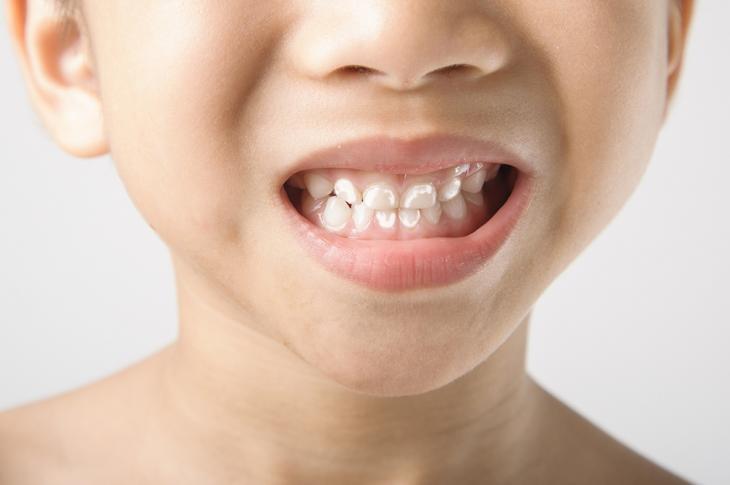 Imagem de uma criança com manchas brancas nos dentes