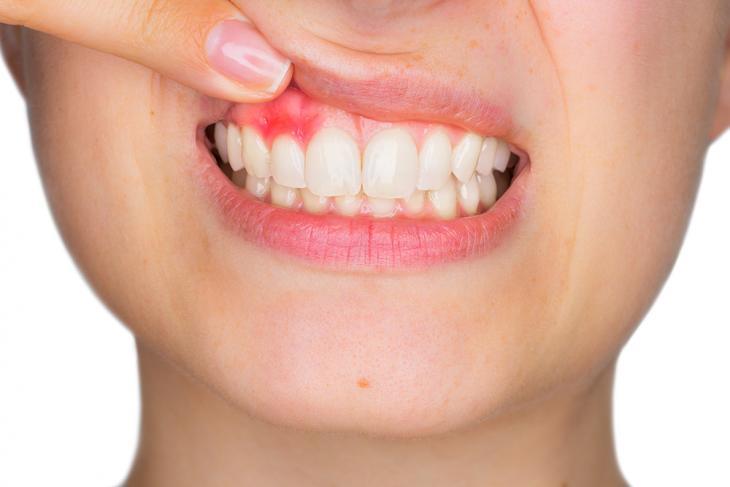 Imagem de uma pessoa mostrando a gengiva inflamada e avermelhada, indicando possível gengivite e necessidade de cuidados